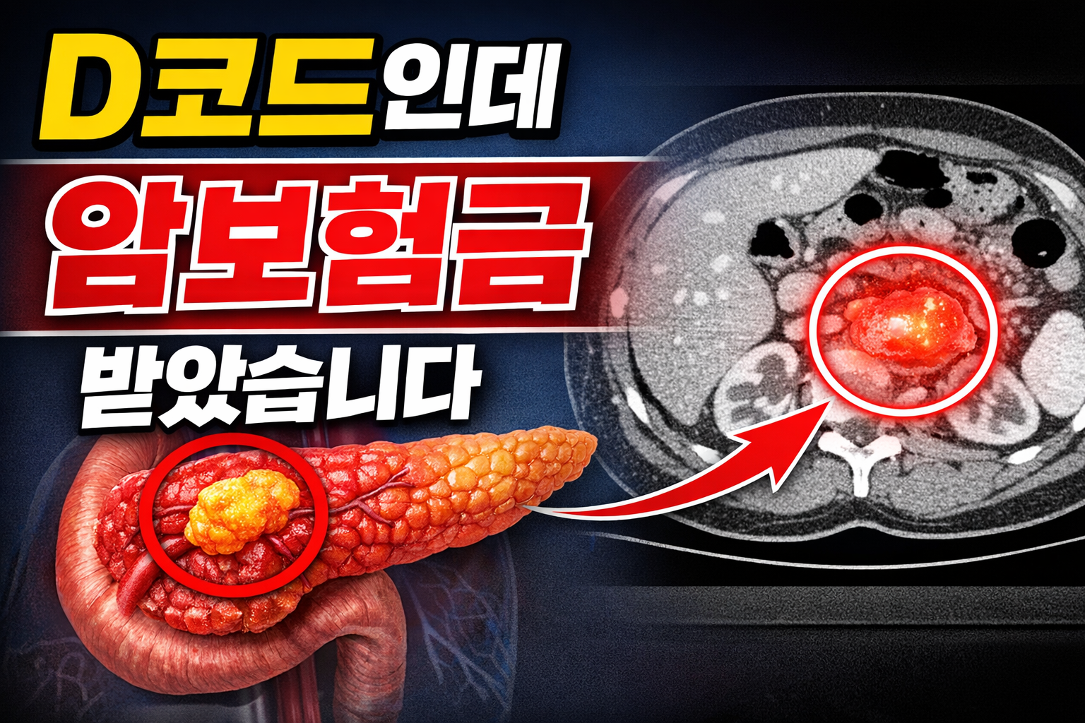 췌장 인슐린종 암진단비 D13.7 보험금 사례