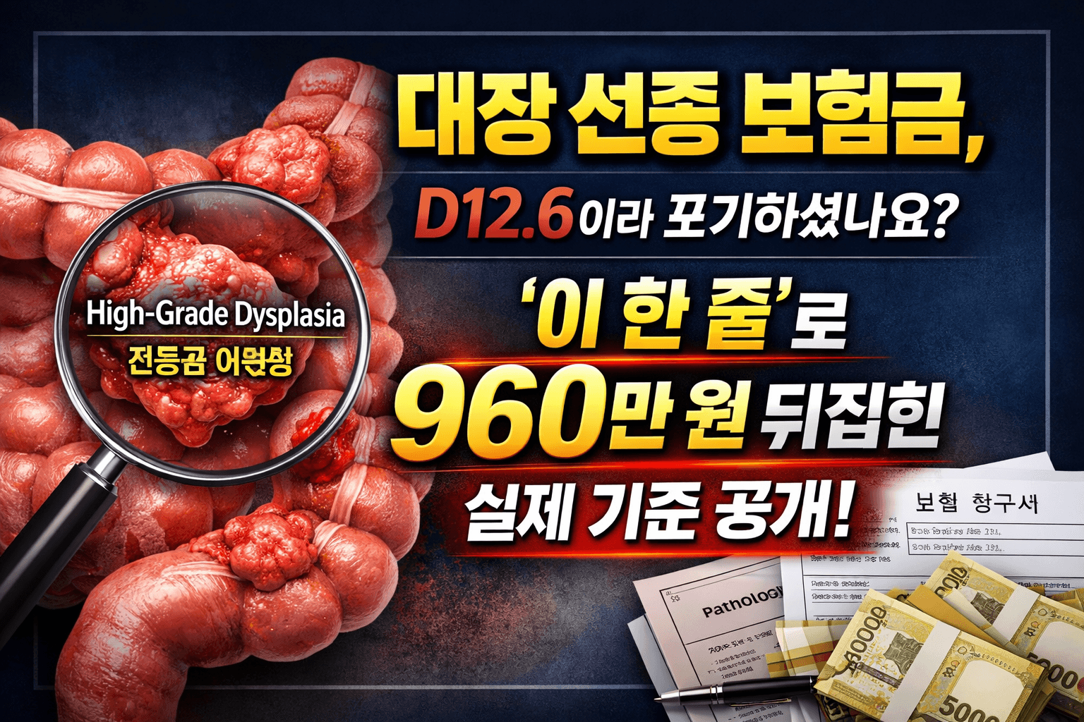 대장 선종 보험금 D12.6 코드에서도 고등급 이형성으로 960만 원 보상 가능성을 설명하는 썸네일 이미지