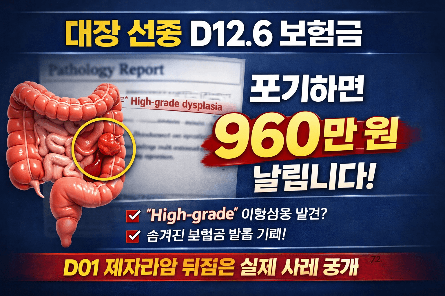 대장 선종 D12.6 보험금 960만 원 제자리암 인정 사례 썸네일