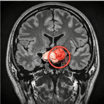 “뇌하수체 선종 MRI 침윤 사례”